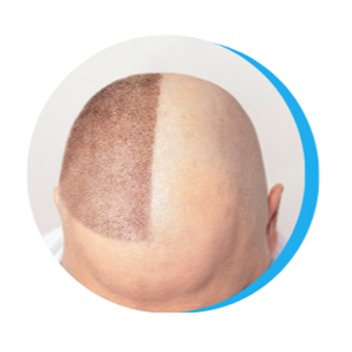 turkey hair transplant1