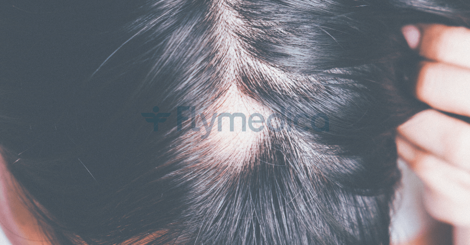 Alopecia Areata (kreisrunder Haarausfall durch Stress) – Symptome und Behandlung