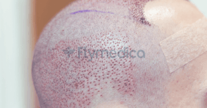 Haartransplantation Schmerzen Wie schmerzhaft ist der Eingriff wirklich und was passiert im Spenderbereich