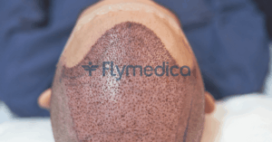 Haartransplantation Türkei Kosten 2026 Deutschland vs Türkei – Preise, Grafts und Klinikvergleich