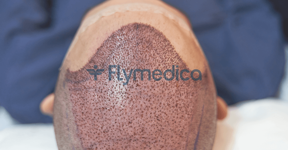 Haartransplantation Türkei Kosten 2026 Deutschland vs Türkei – Preise, Grafts und Klinikvergleich