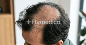 haartransplantation tonsur